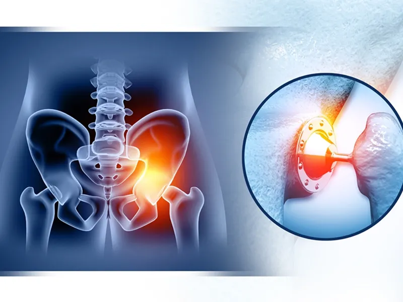 Joint Replacement Model